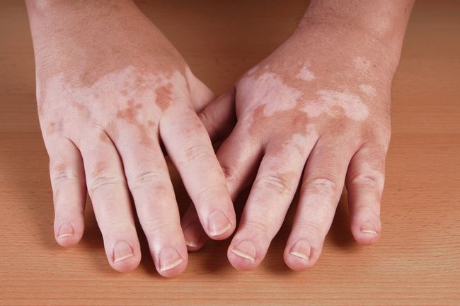 Penyebab penyakit vitiligo menurut islam